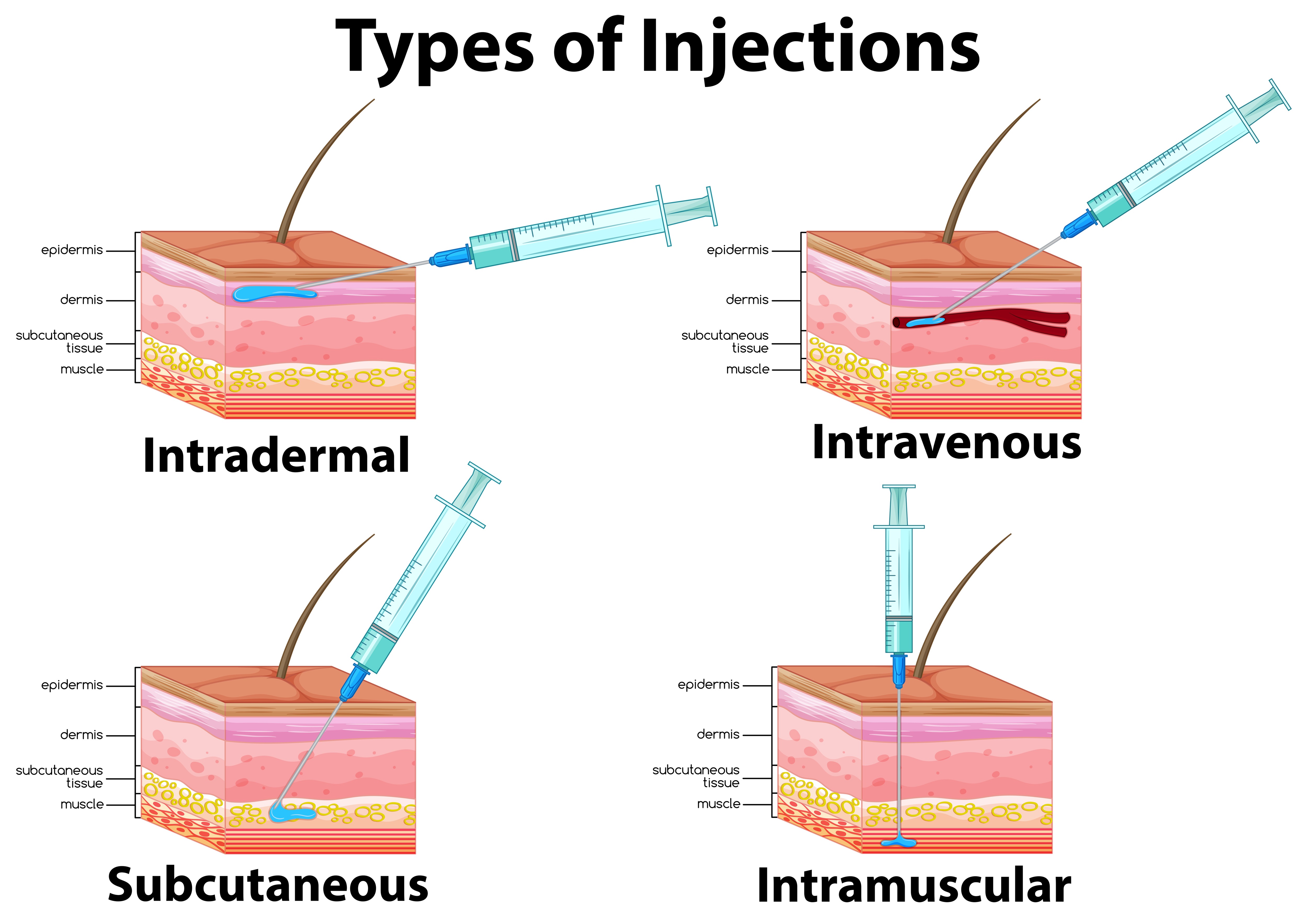 what-is-an-intramusclar-injection
